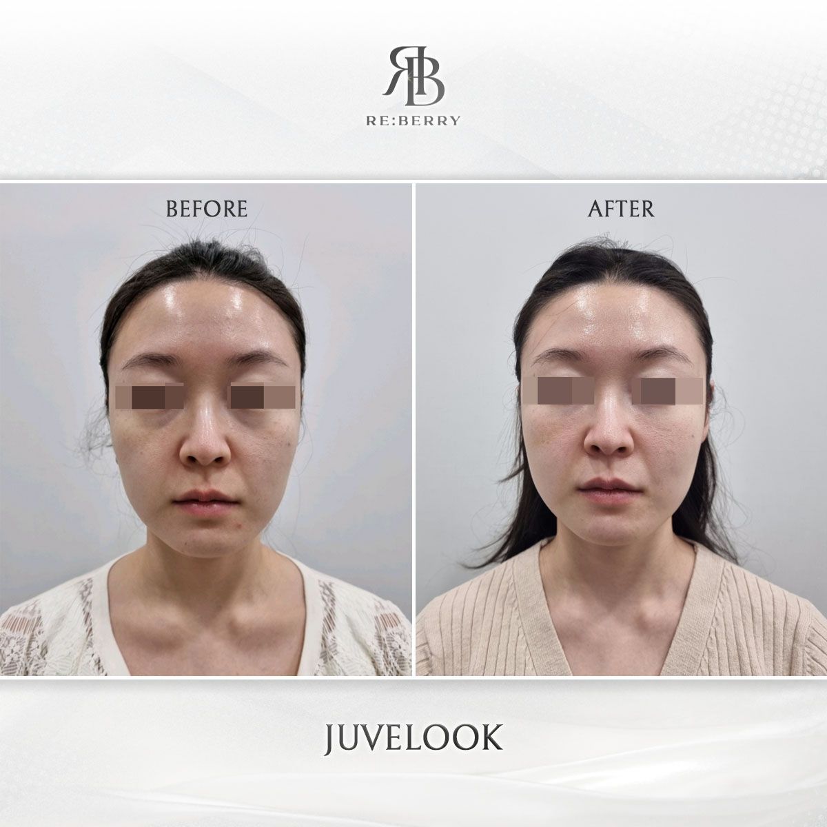 Juvelook before and after at RE:BERRY Clinic Myeongdong