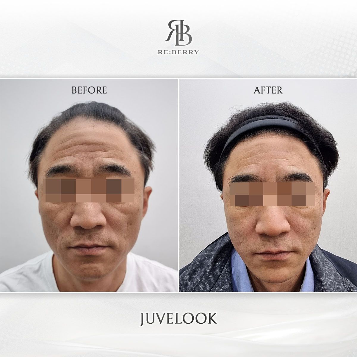Juvelook before and after photo 2, RE:BERRY Clinic Myeongdong