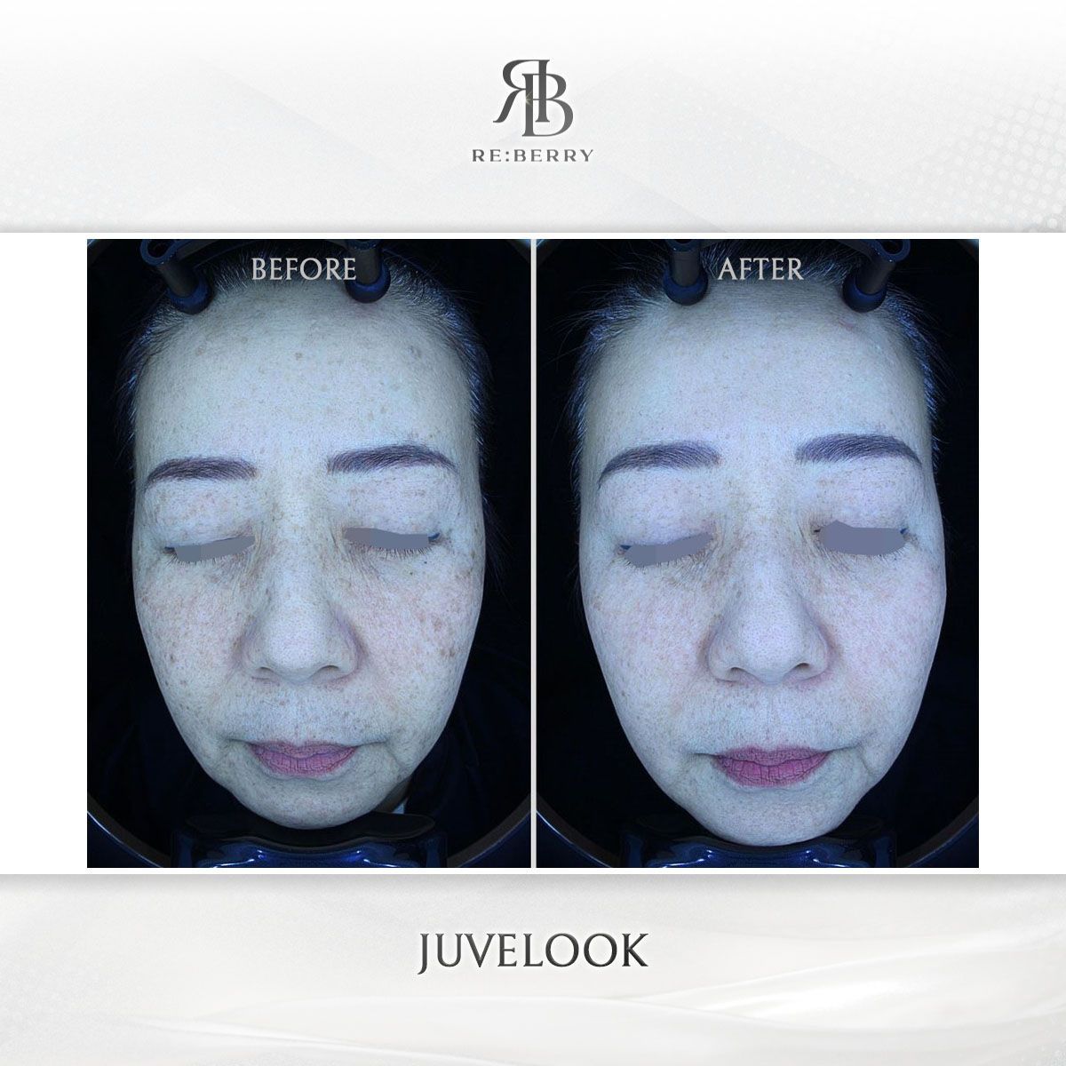 Juvelook before and after photo 12, RE:BERRY Clinic Myeongdong
