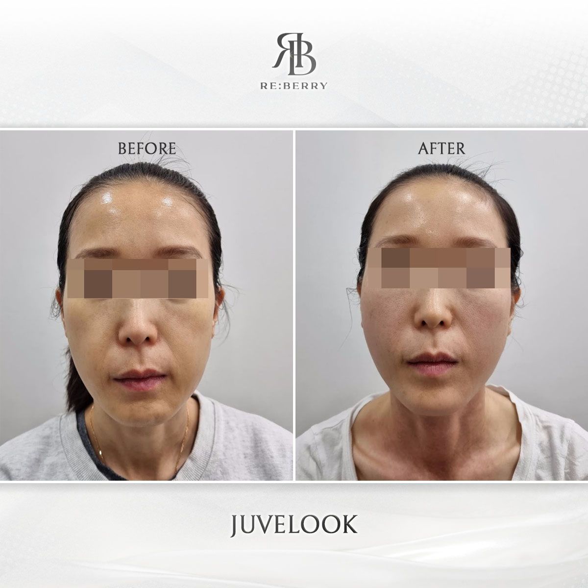 Juvelook before and after photo 15, RE:BERRY Clinic Myeongdong