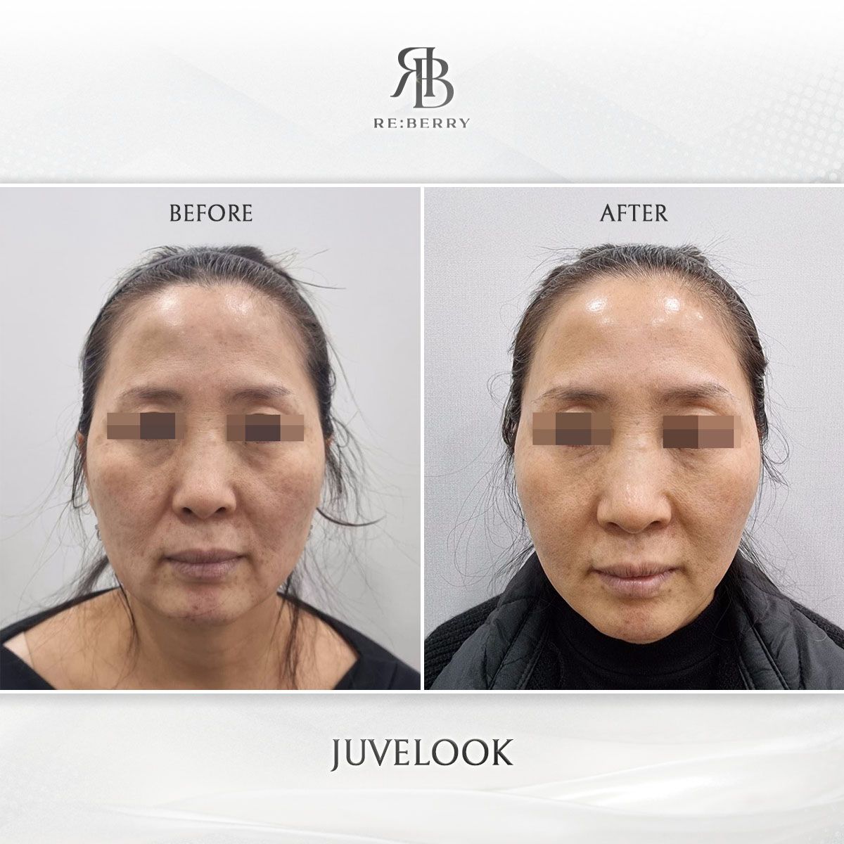 Juvelook before and after photo 16, RE:BERRY Clinic Myeongdong