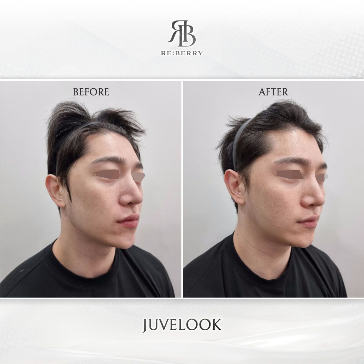 Juvelook before and after photo 3, RE:BERRY Clinic Myeongdong