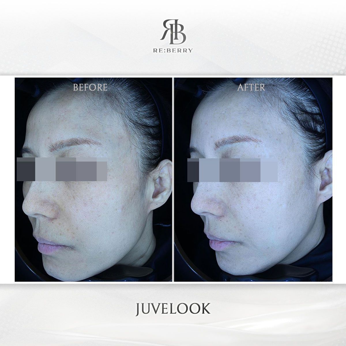Juvelook before and after photo 5, RE:BERRY Clinic Myeongdong