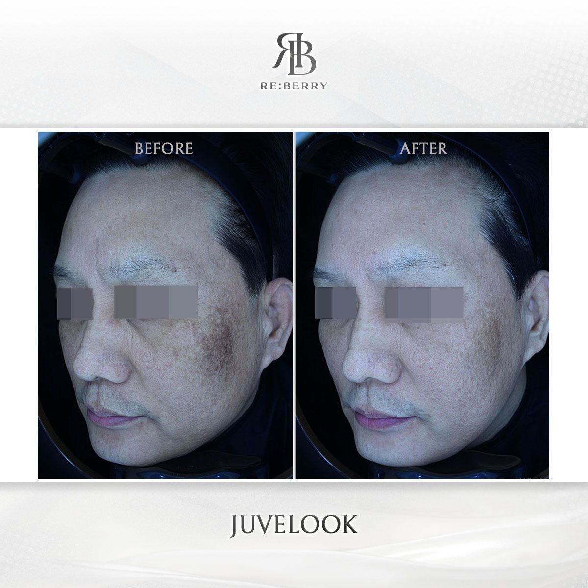 Juvelook before and after photo 9, RE:BERRY Clinic Myeongdong