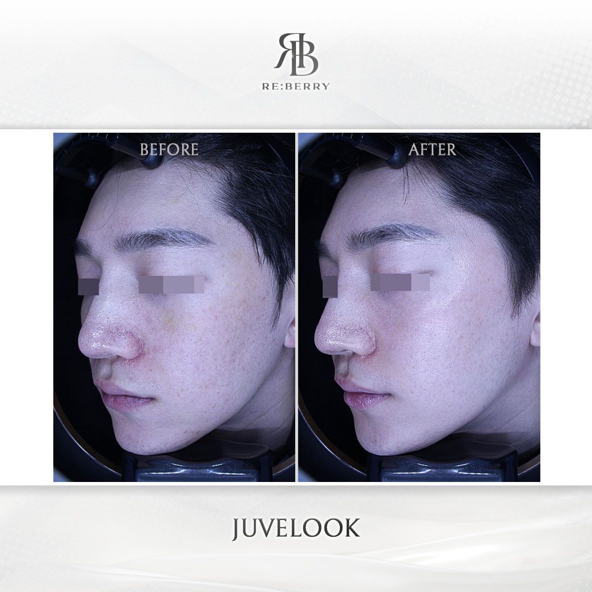 Juvelook before and after photo 10, RE:BERRY Clinic Myeongdong