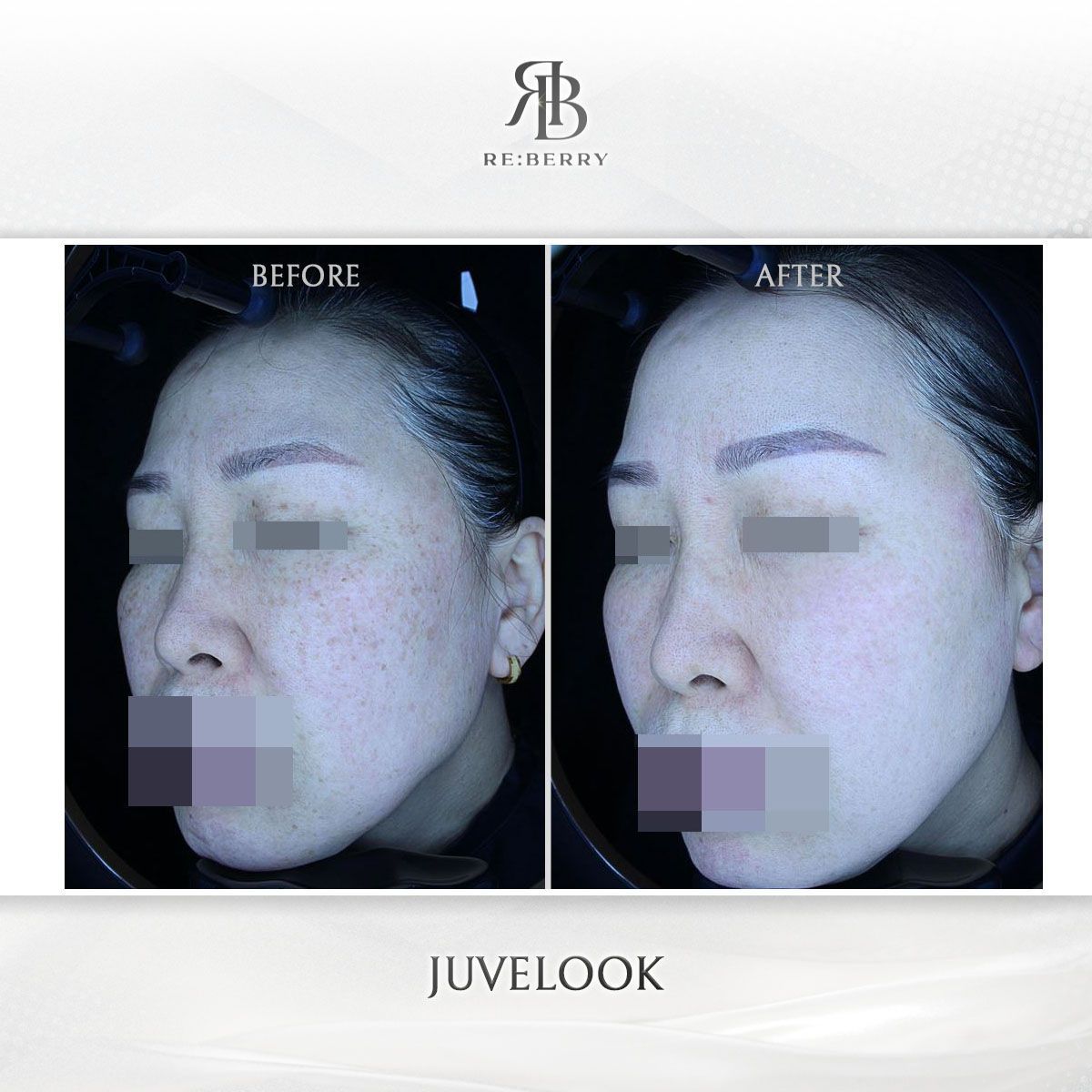Juvelook before and after photo 11, RE:BERRY Clinic Myeongdong