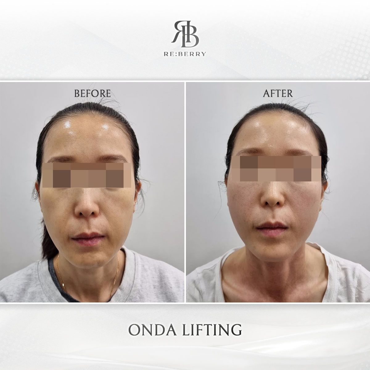 Onda Lifting before and after photo 12, RE:BERRY Clinic Myeongdong