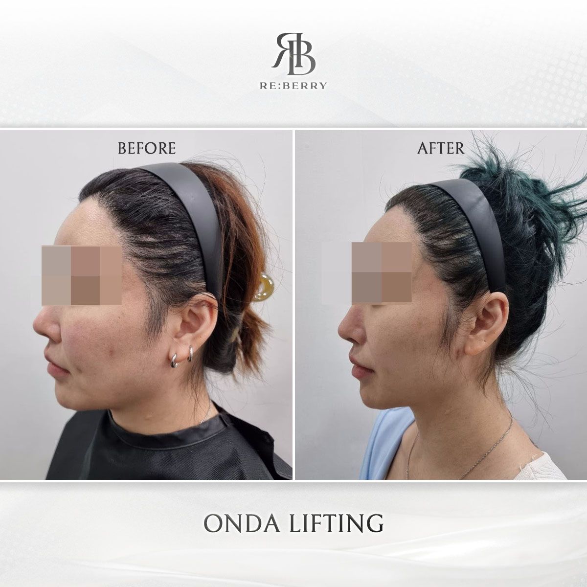 Onda Lifting before and after photo 2, RE:BERRY Clinic Myeongdong