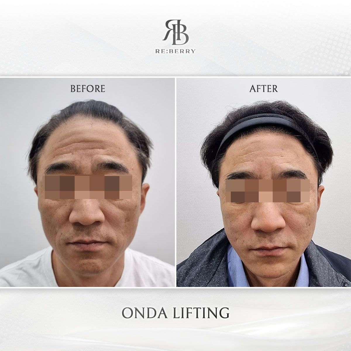 Onda Lifting before and after photo 3, RE:BERRY Clinic Myeongdong