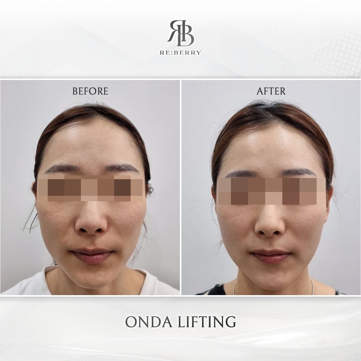 Onda Lifting before and after photo 7, RE:BERRY Clinic Myeongdong