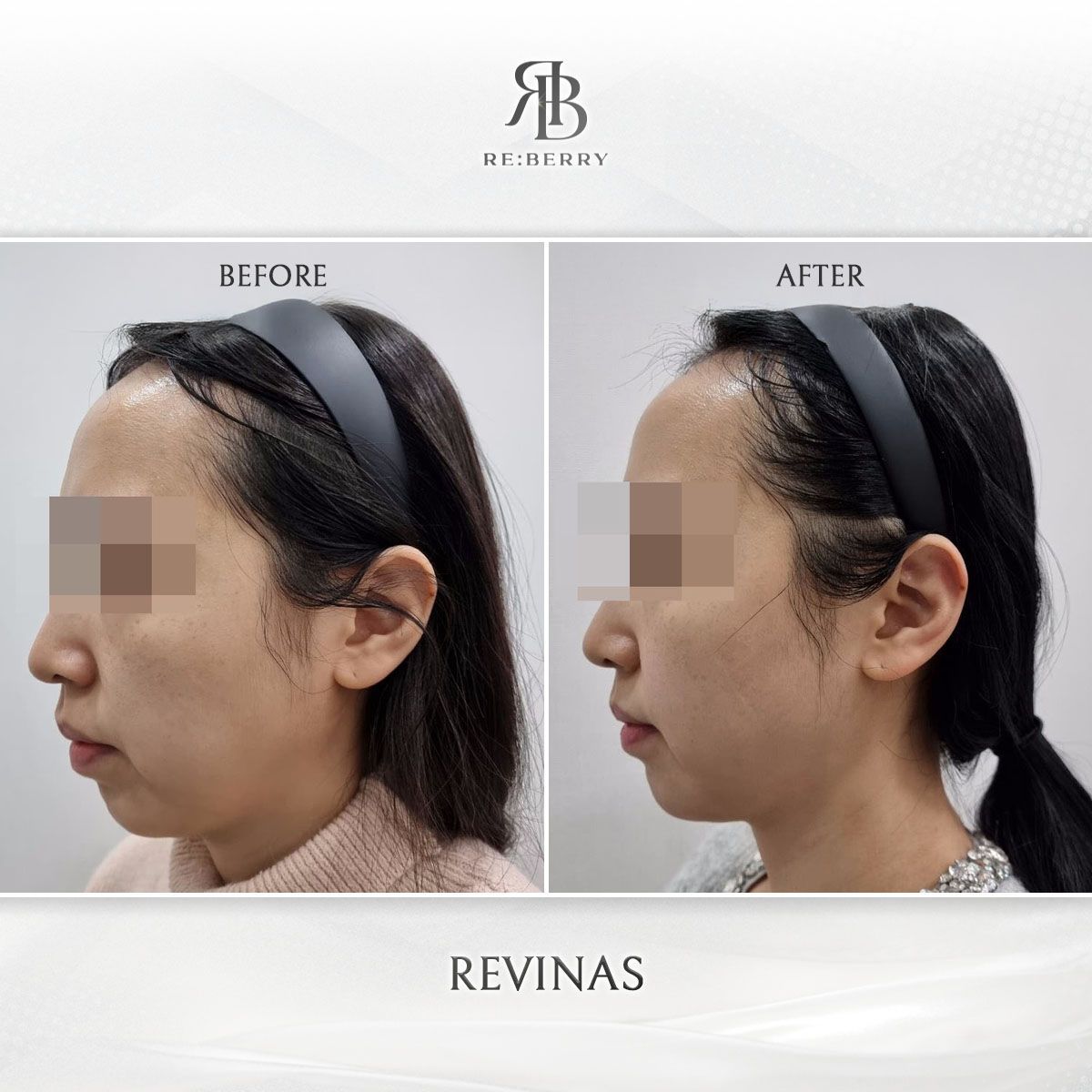 Revinas before and after photo 2, RE:BERRY Clinic Myeongdong