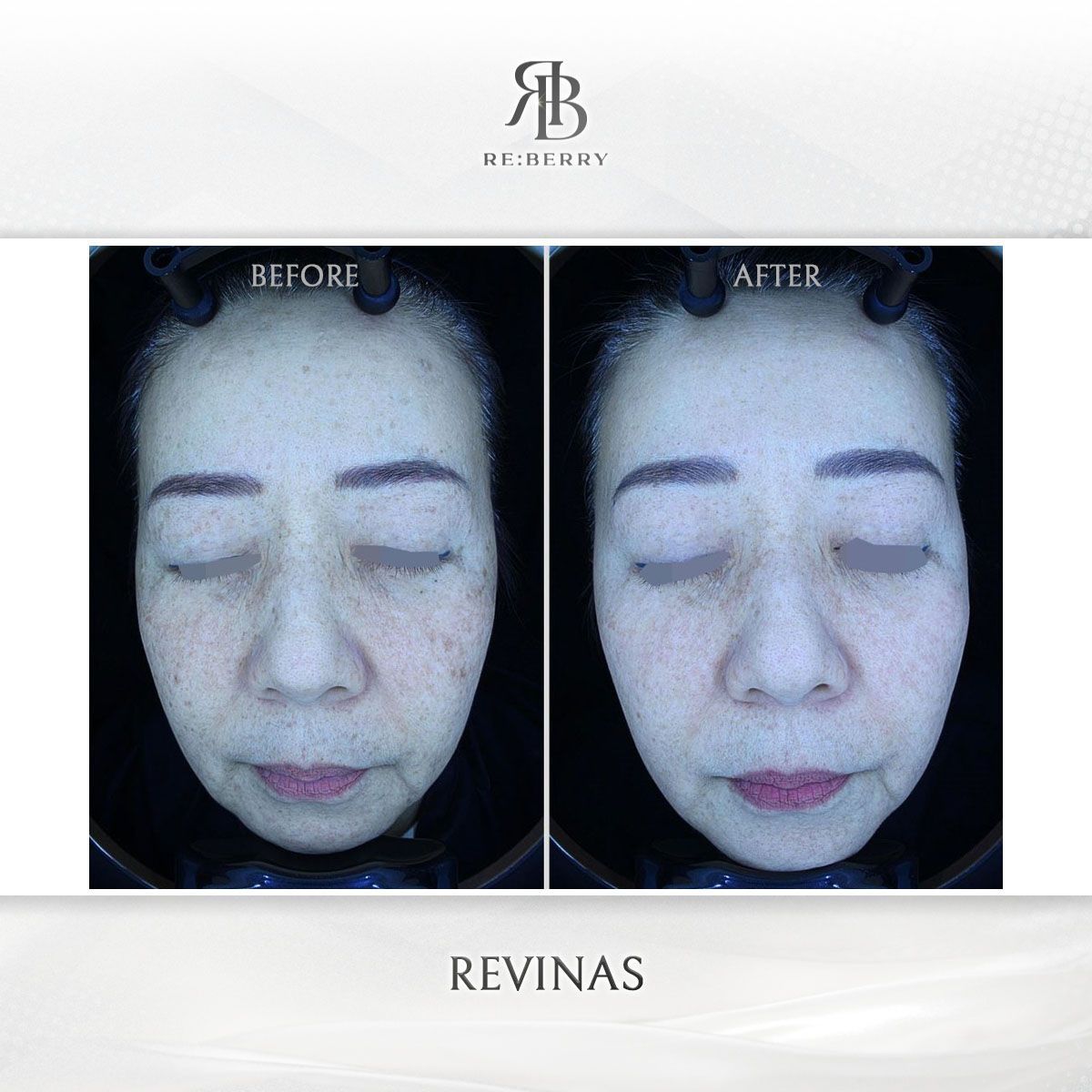 Revinas before and after photo 13, RE:BERRY Clinic Myeongdong
