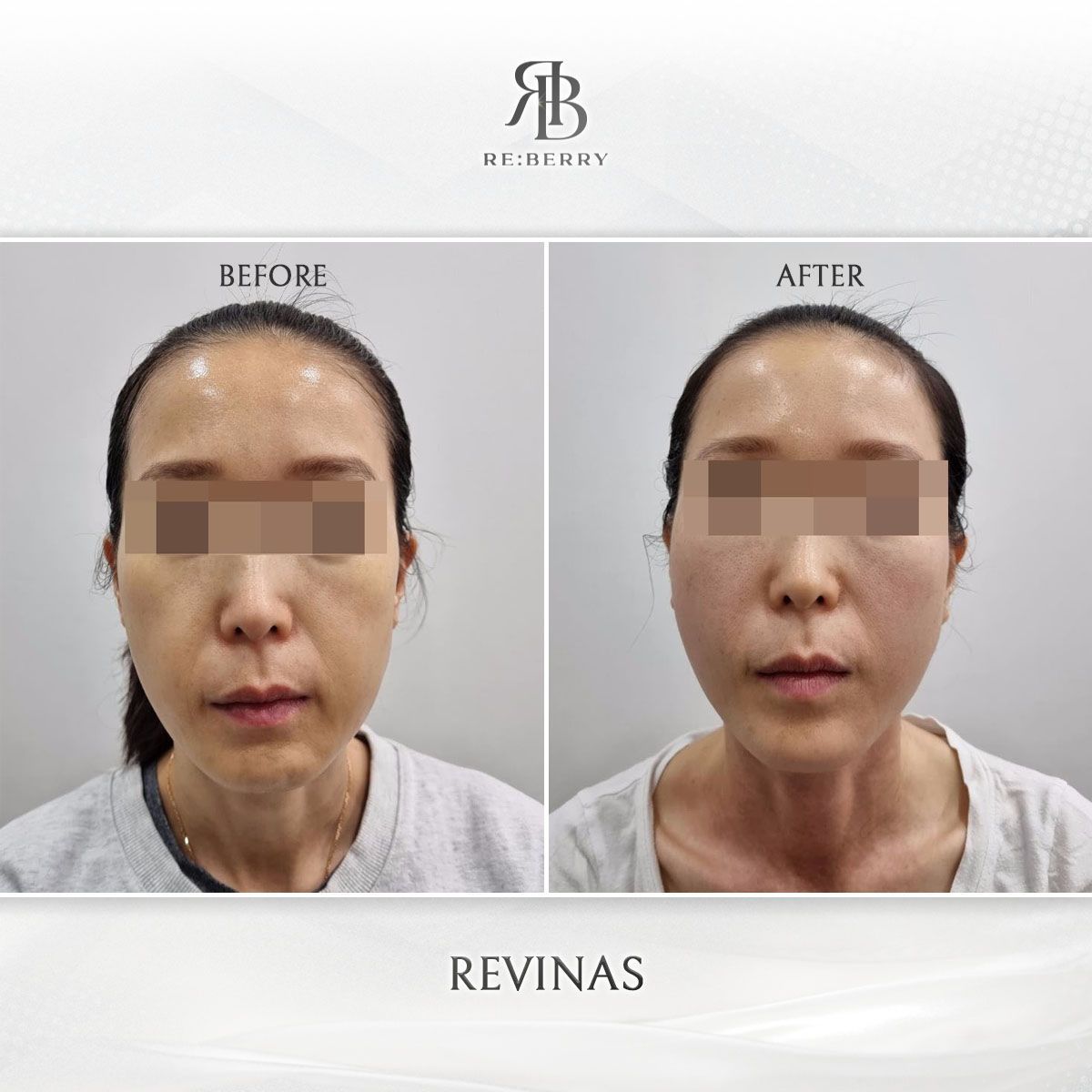Revinas before and after photo 17, RE:BERRY Clinic Myeongdong