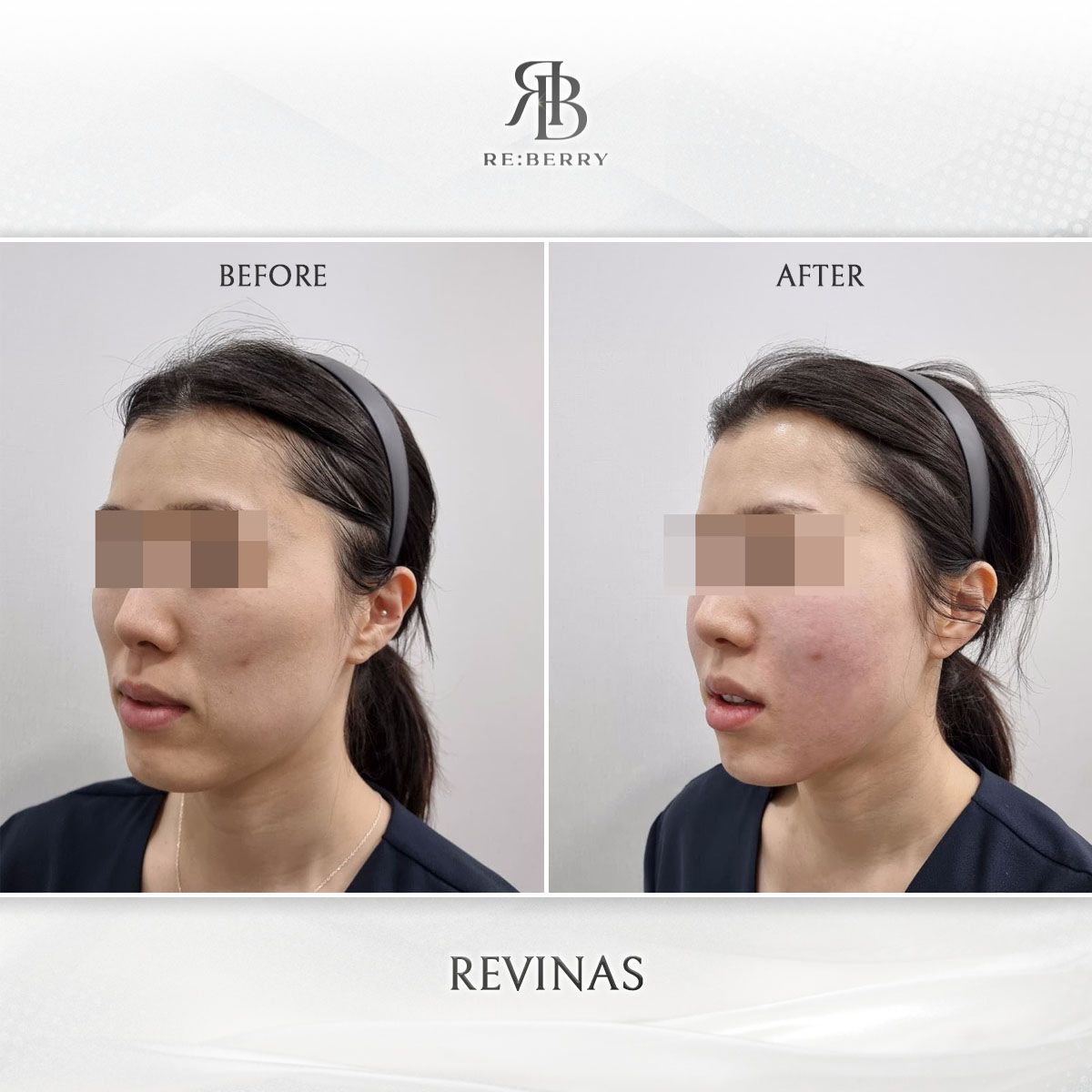 Revinas before and after photo 3, RE:BERRY Clinic Myeongdong