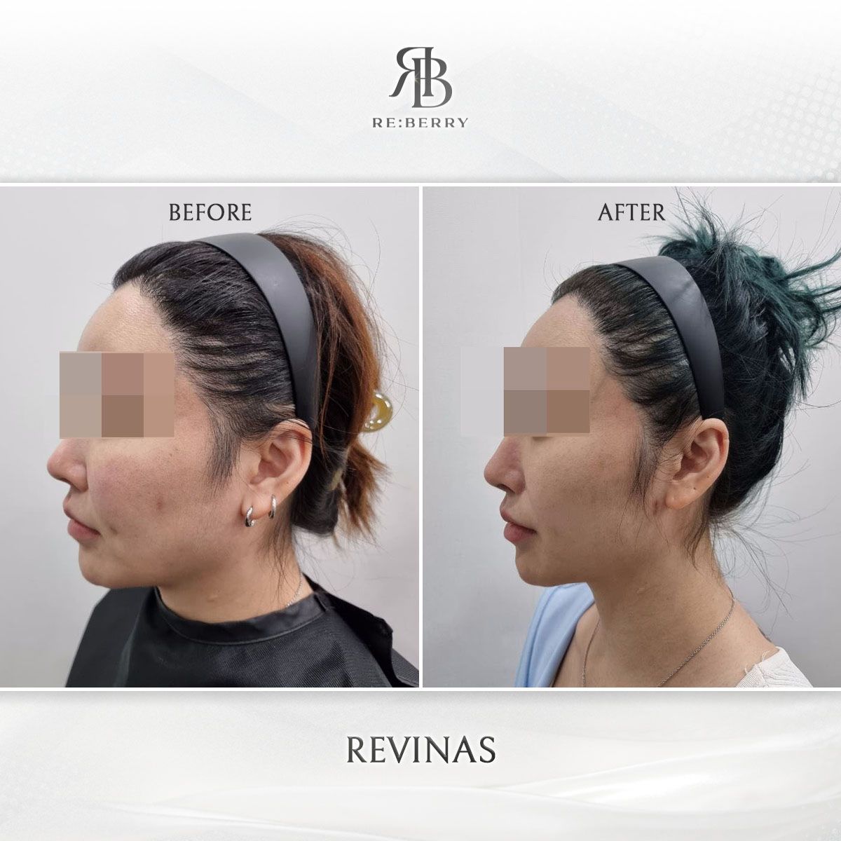 Revinas before and after photo 4, RE:BERRY Clinic Myeongdong