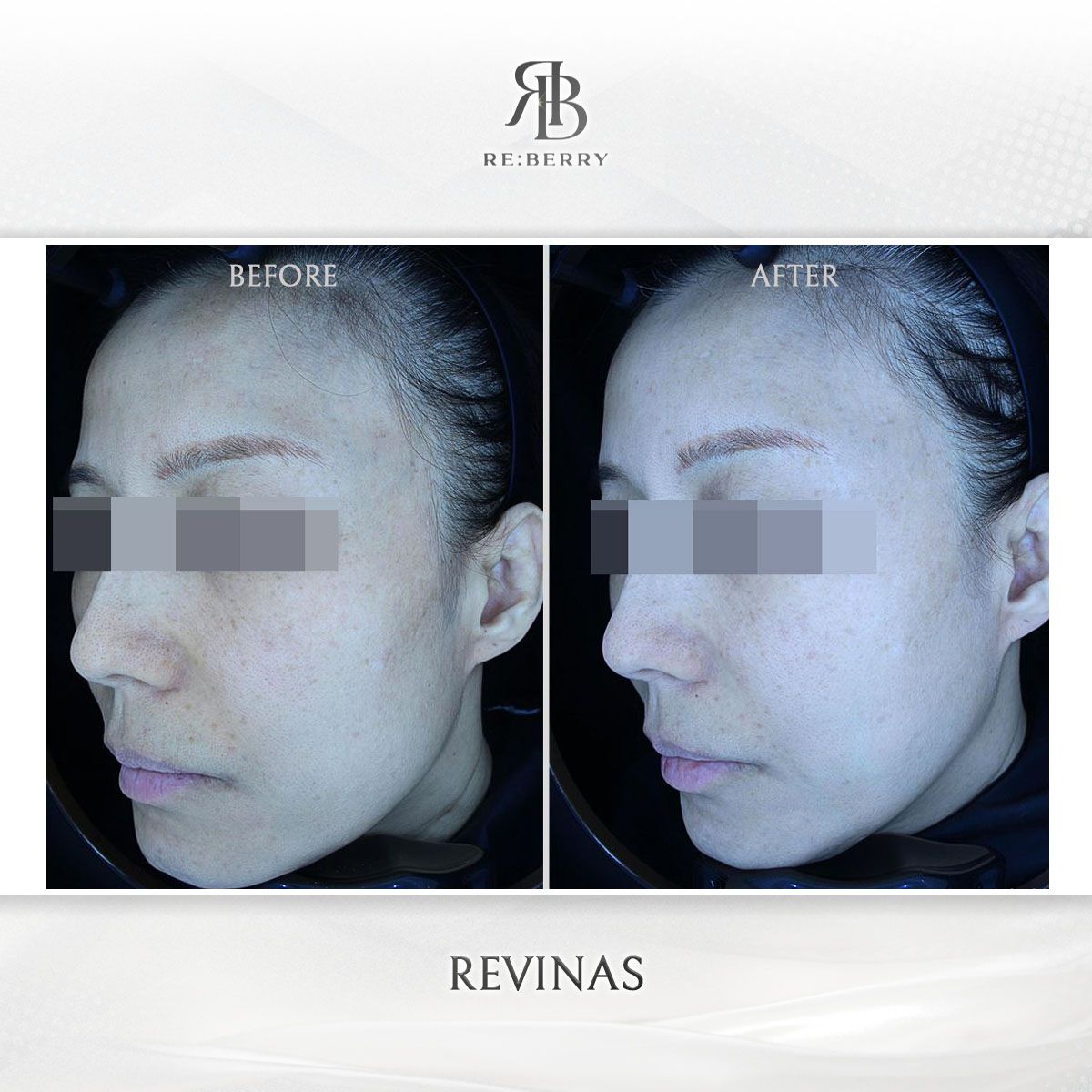 Revinas before and after photo 8, RE:BERRY Clinic Myeongdong