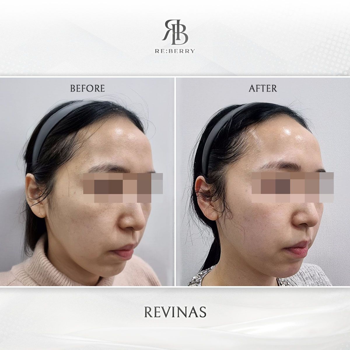 Revinas before and after photo 9, RE:BERRY Clinic Myeongdong