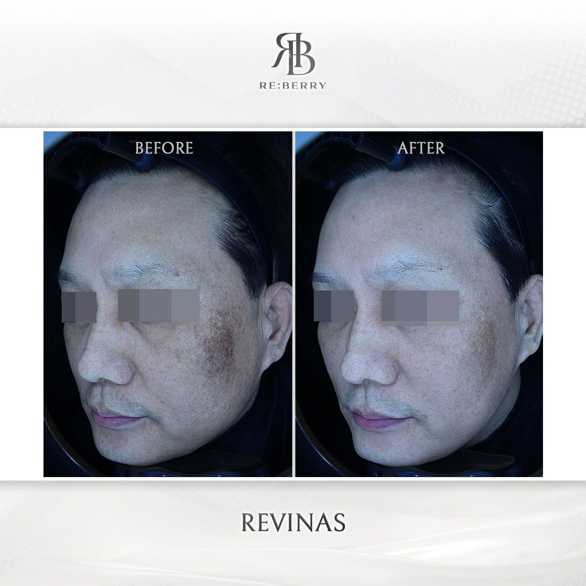 Revinas before and after photo 11, RE:BERRY Clinic Myeongdong