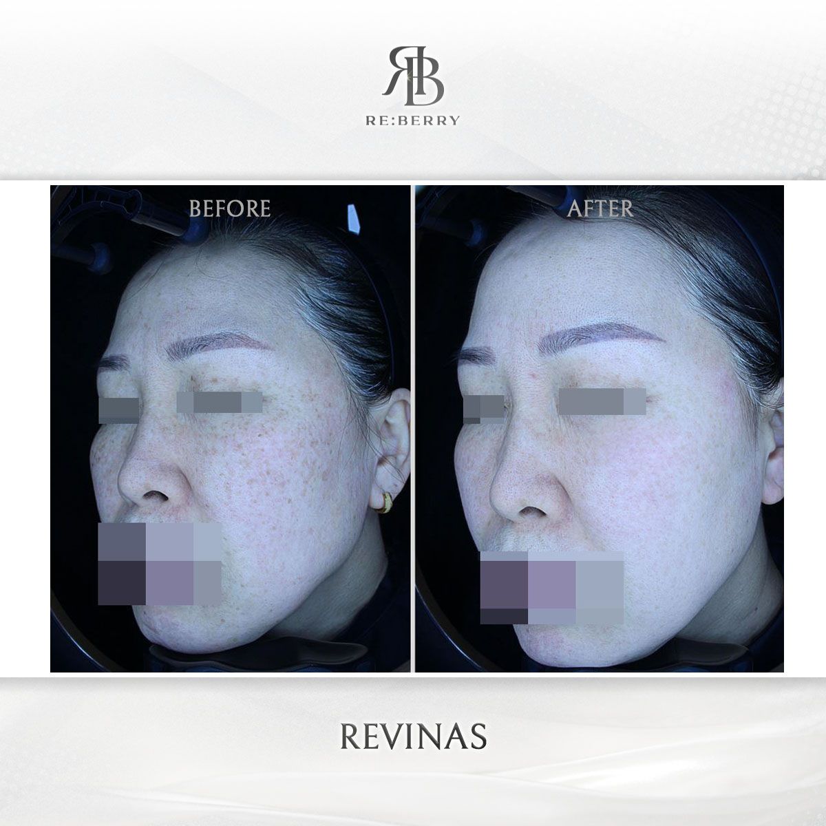 Revinas before and after photo 12, RE:BERRY Clinic Myeongdong