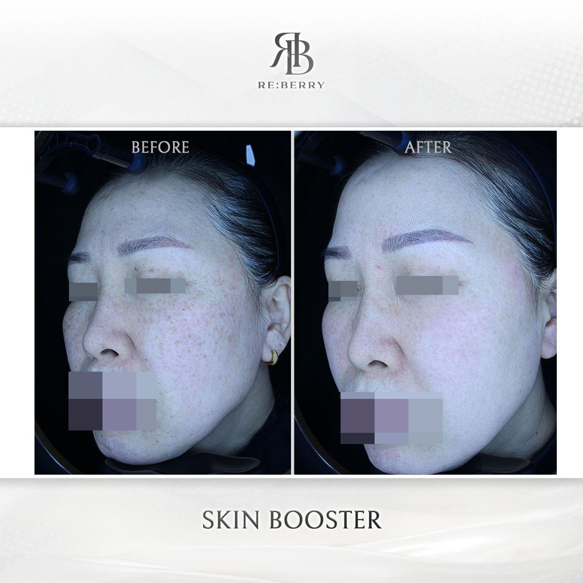 Skin Boosters before and after photo 2, RE:BERRY Clinic Myeongdong
