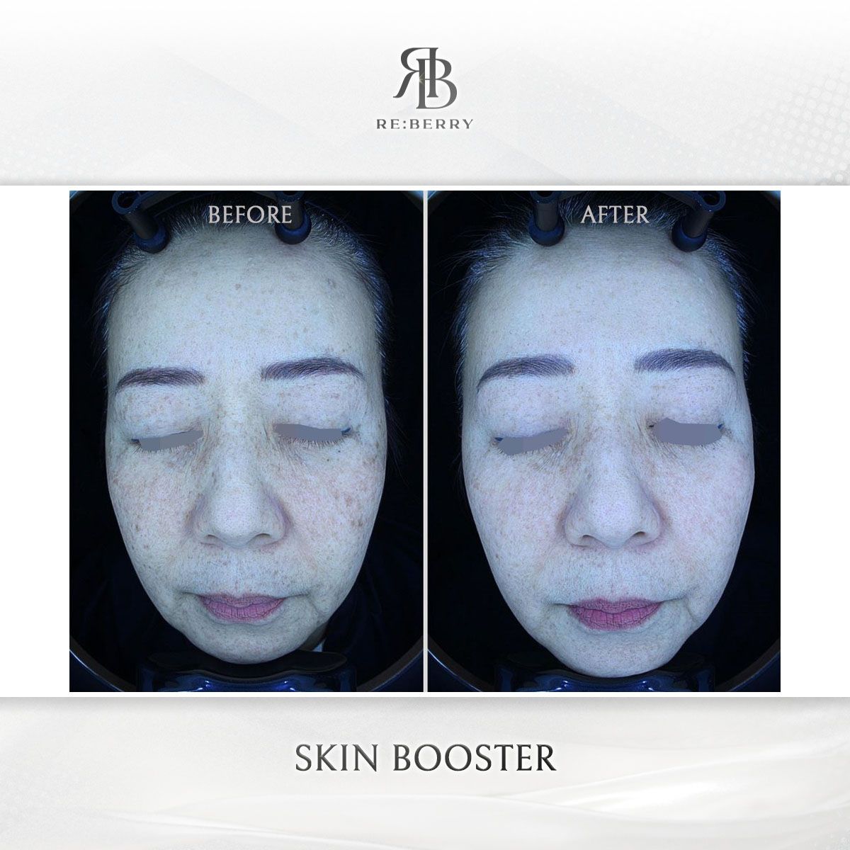 Skin Boosters before and after photo 3, RE:BERRY Clinic Myeongdong
