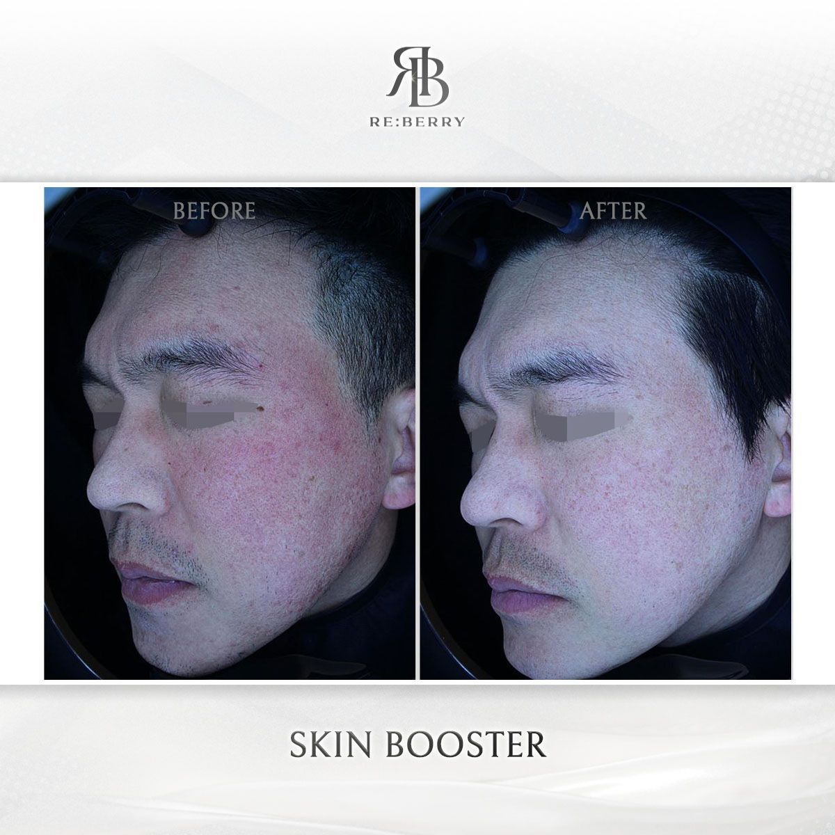 Skin Boosters before and after photo 4, RE:BERRY Clinic Myeongdong