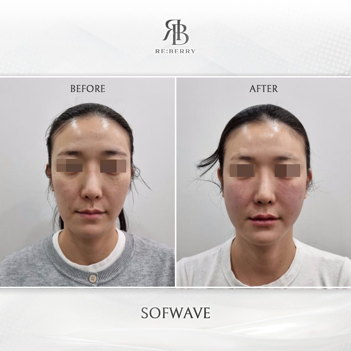 Sofwave before and after photo 1, RE:BERRY Clinic Myeongdong
