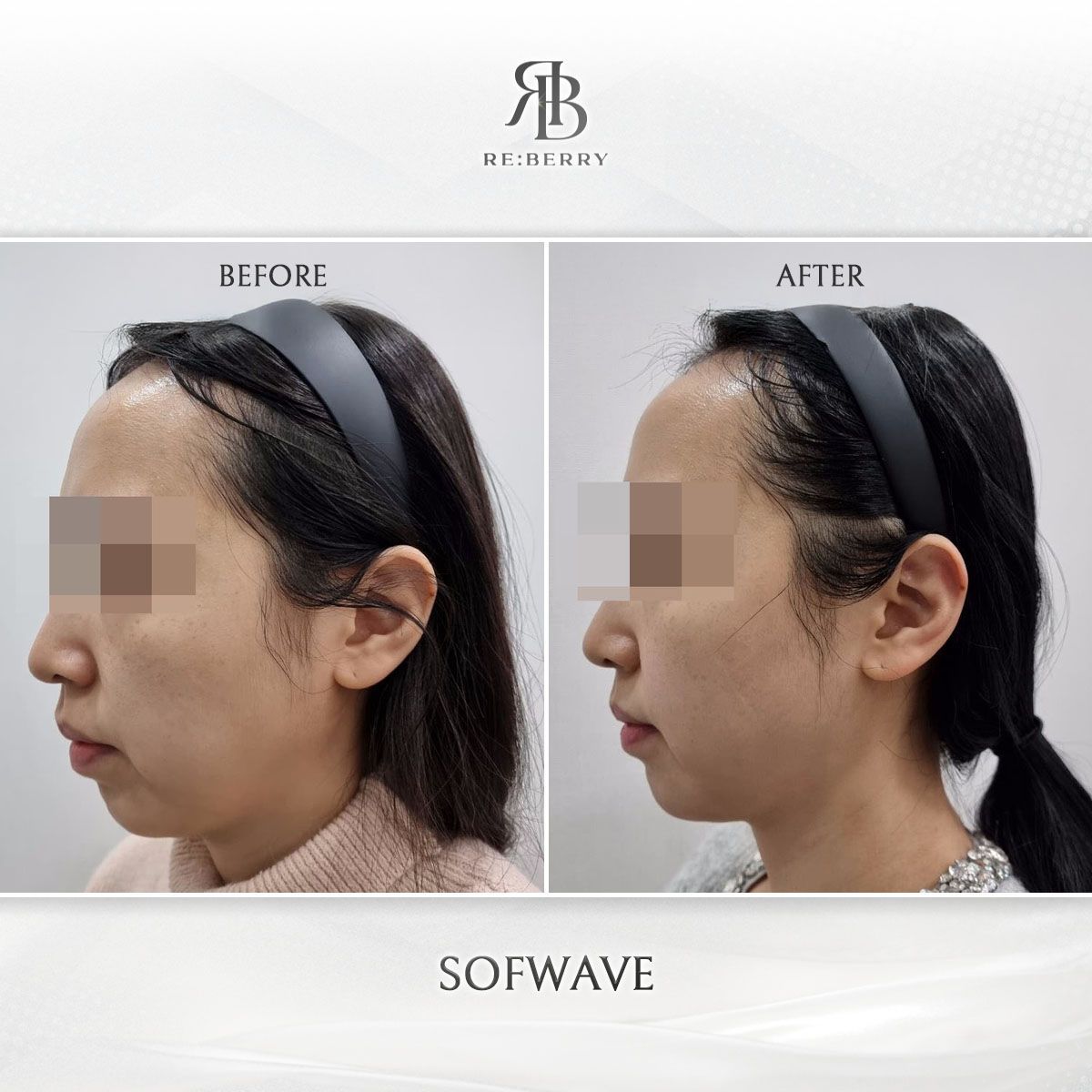 Sofwave before and after photo 2, RE:BERRY Clinic Myeongdong