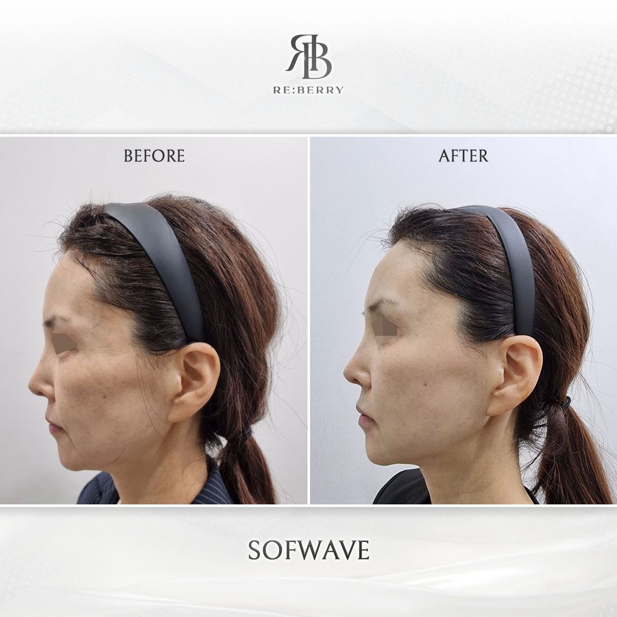 Sofwave before and after photo 14, RE:BERRY Clinic Myeongdong