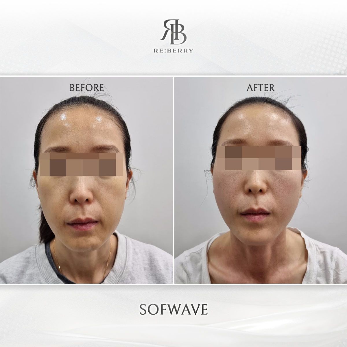 Sofwave before and after photo 15, RE:BERRY Clinic Myeongdong
