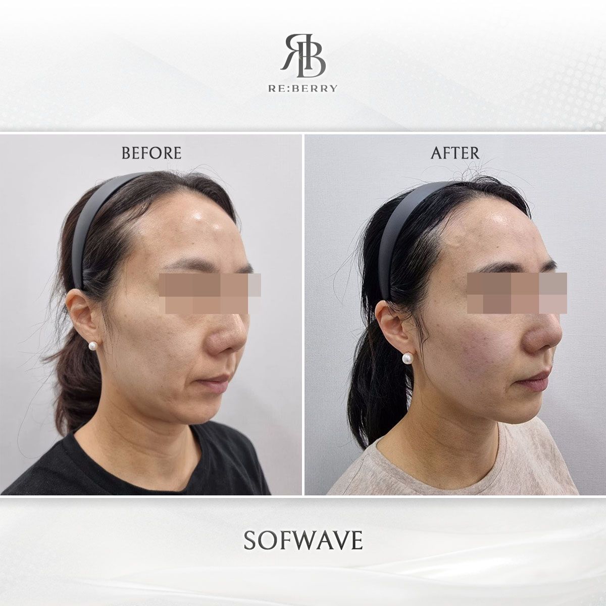 Sofwave before and after photo 16, RE:BERRY Clinic Myeongdong
