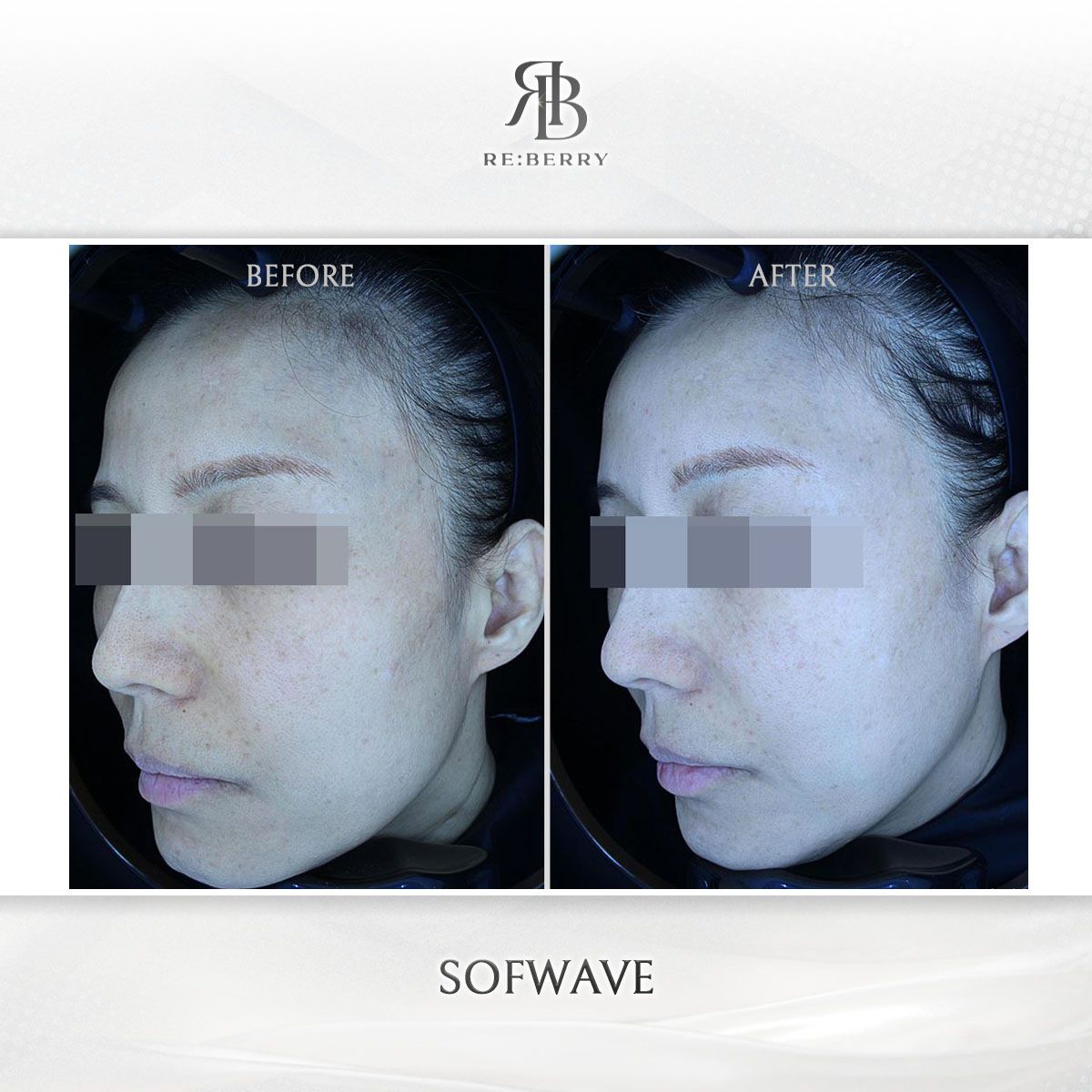 Sofwave before and after photo 8, RE:BERRY Clinic Myeongdong