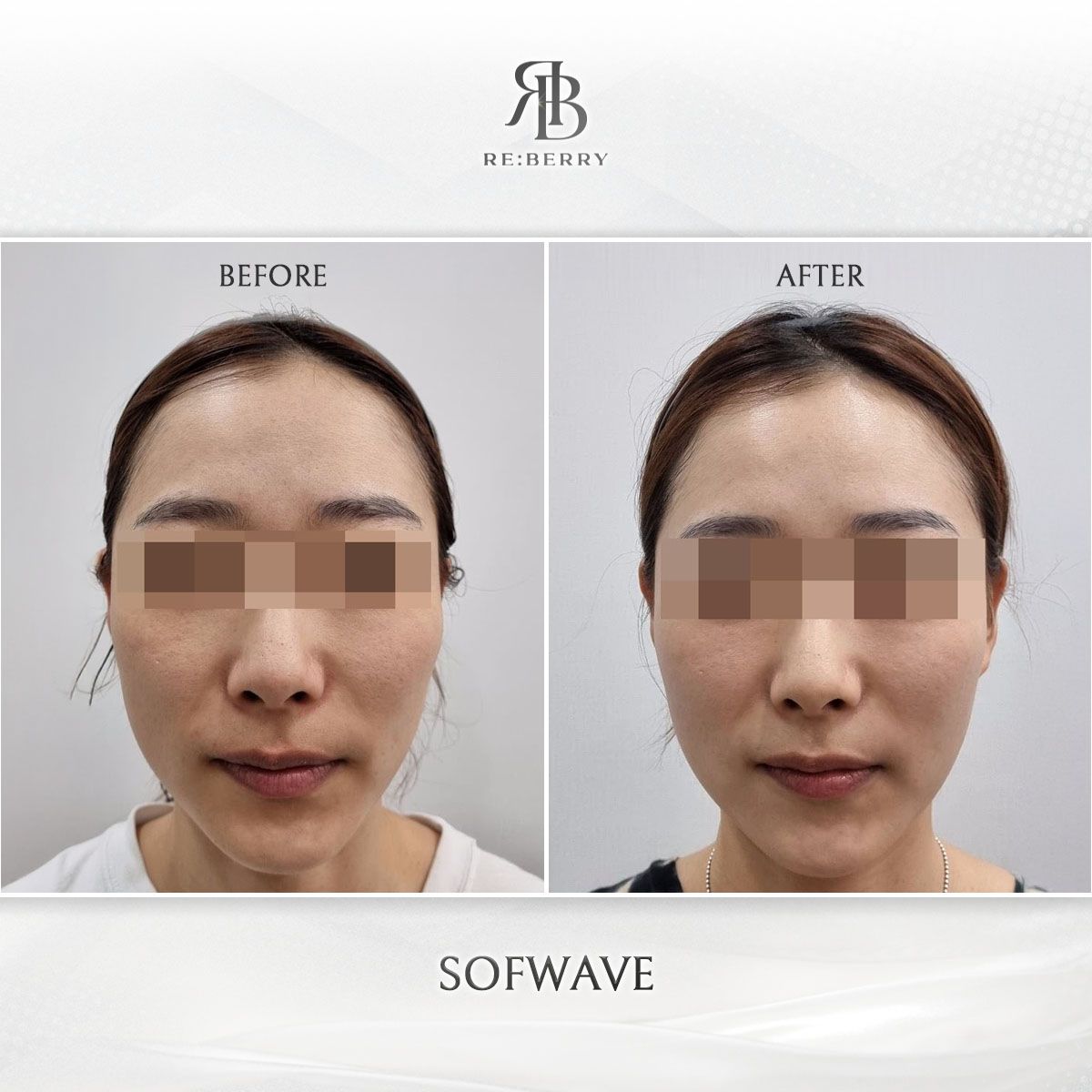 Sofwave before and after photo 10, RE:BERRY Clinic Myeongdong