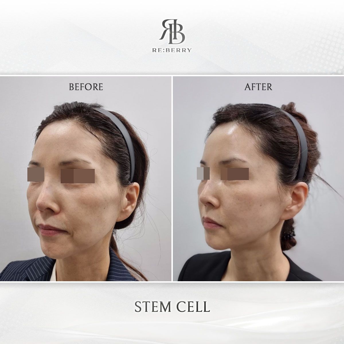 Blood-Derived Stem Cell before and after photo 1, RE:BERRY Clinic Myeongdong