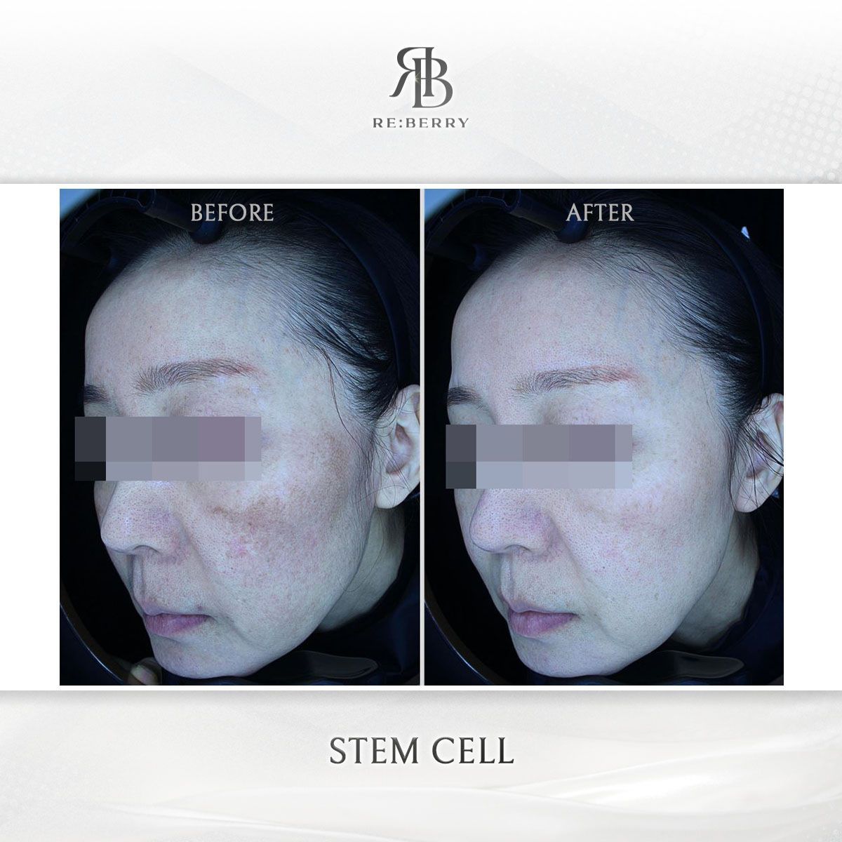 Blood-Derived Stem Cell before and after photo 3, RE:BERRY Clinic Myeongdong