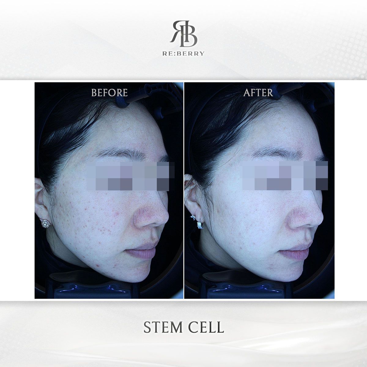 Blood-Derived Stem Cell before and after photo 4, RE:BERRY Clinic Myeongdong