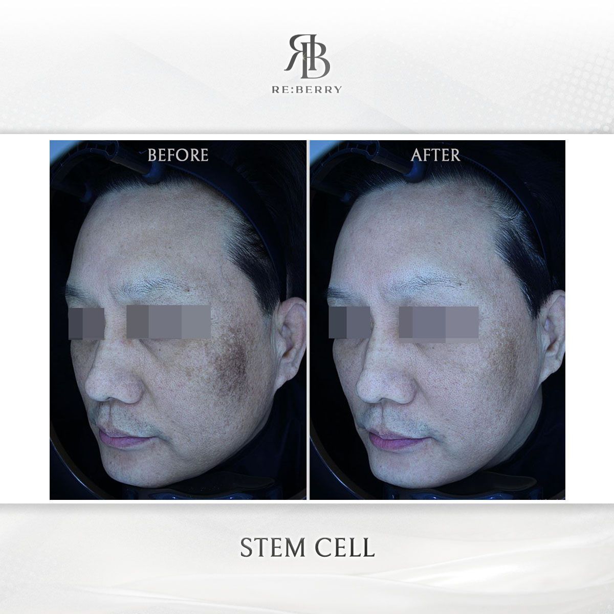 Blood-Derived Stem Cell before and after photo 5, RE:BERRY Clinic Myeongdong