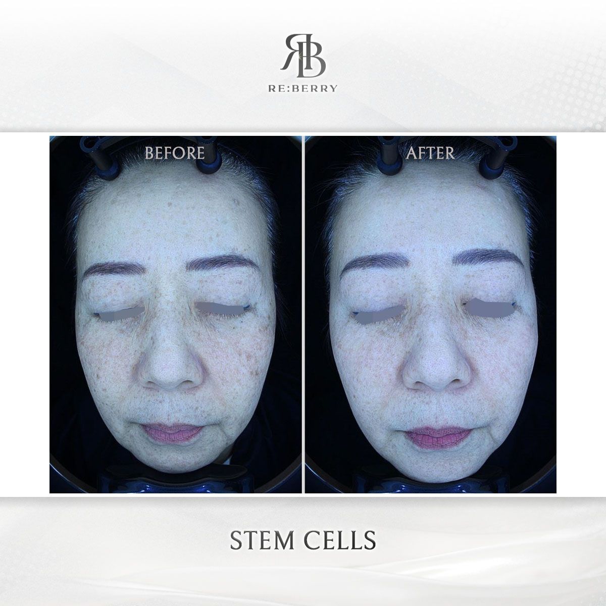 Blood-Derived Stem Cell before and after photo 6, RE:BERRY Clinic Myeongdong