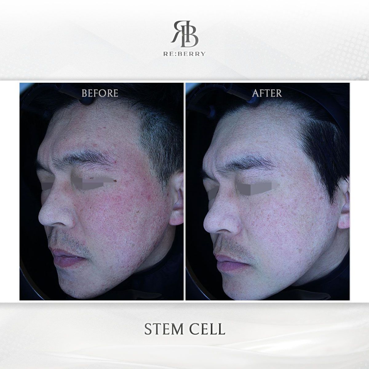 Blood-Derived Stem Cell before and after photo 8, RE:BERRY Clinic Myeongdong