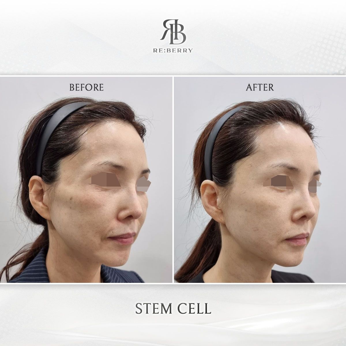 Blood-Derived Stem Cell before and after photo 9, RE:BERRY Clinic Myeongdong