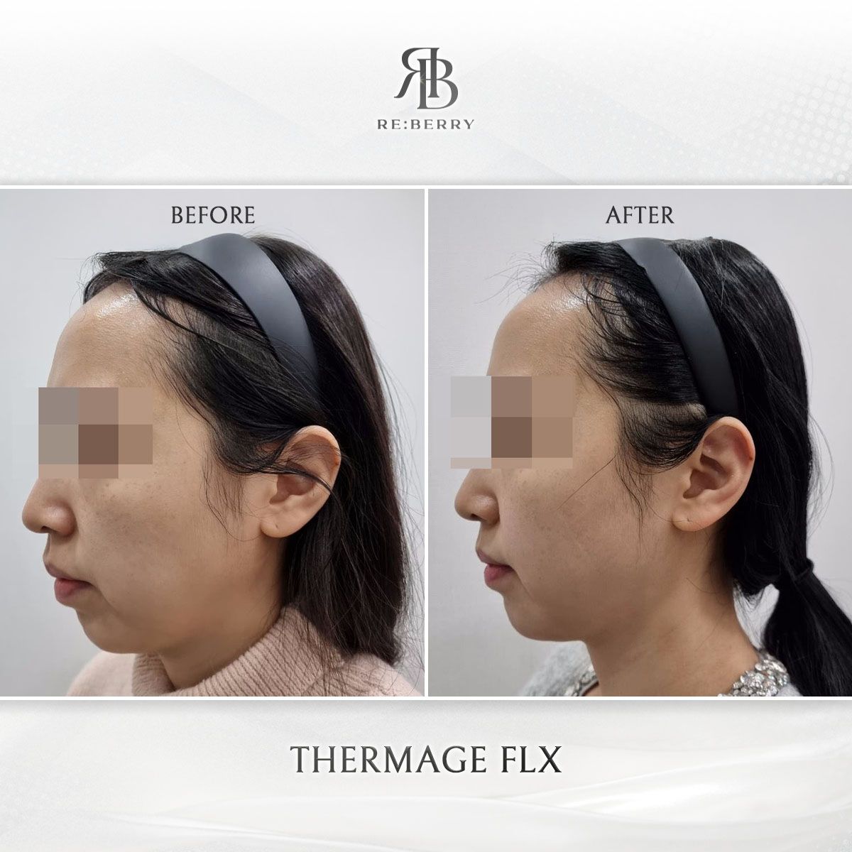 Thermage FLX before and after photo 2, RE:BERRY Clinic Myeongdong