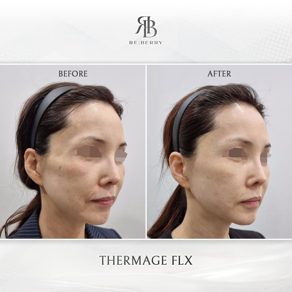 Thermage FLX before and after photo 12, RE:BERRY Clinic Myeongdong