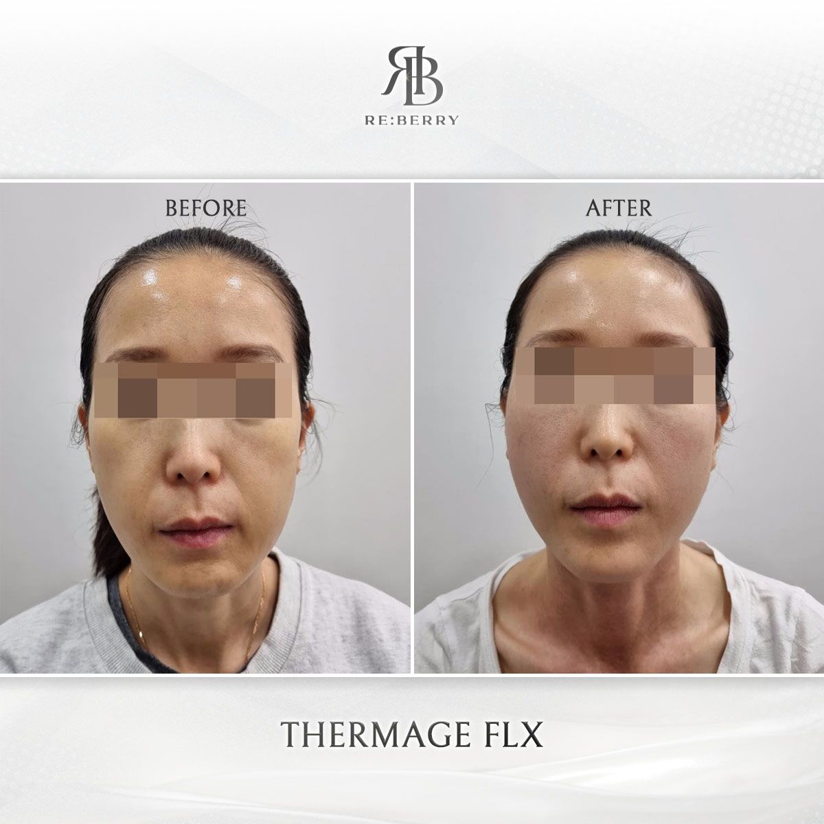 Thermage FLX before and after photo 14, RE:BERRY Clinic Myeongdong