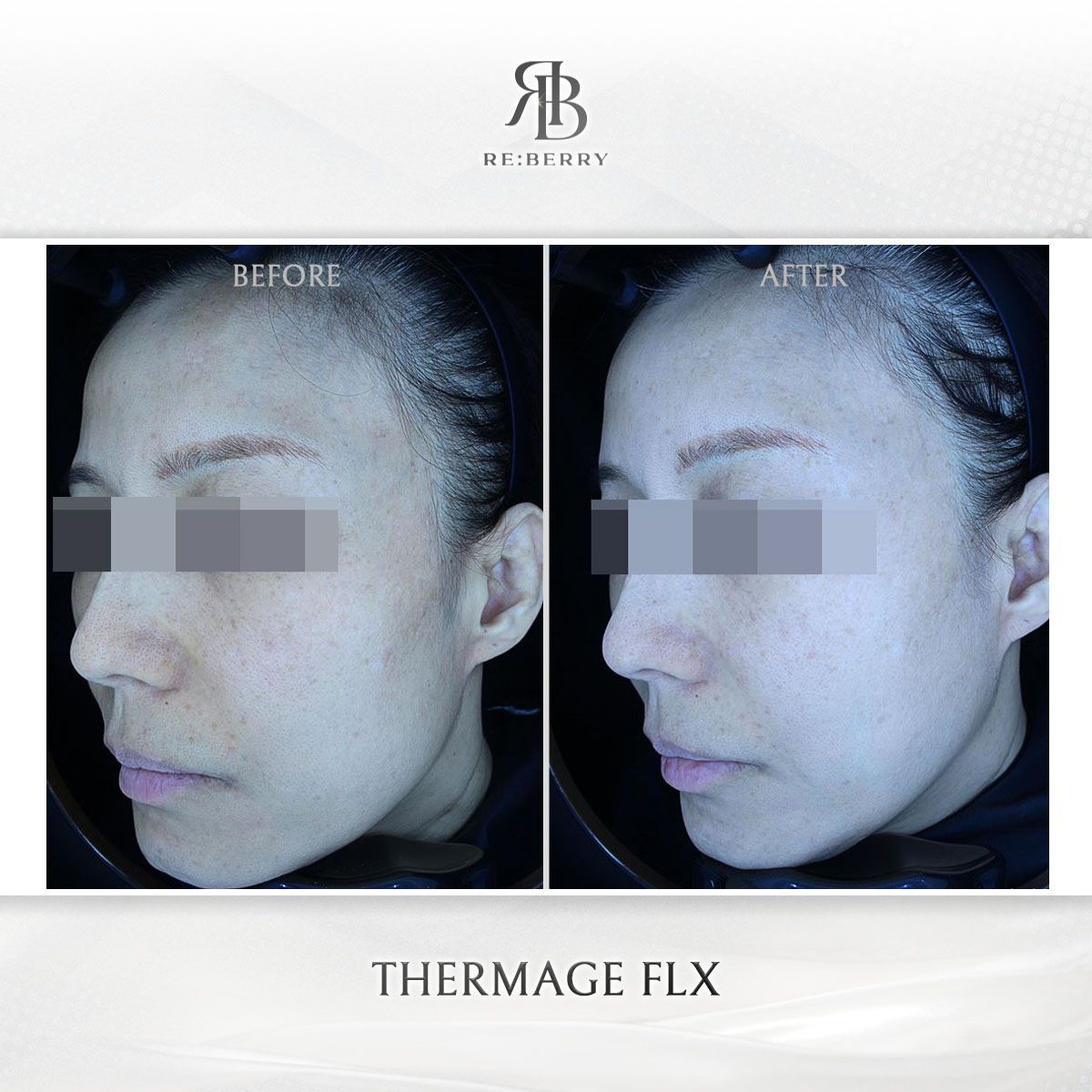 Thermage FLX before and after photo 7, RE:BERRY Clinic Myeongdong