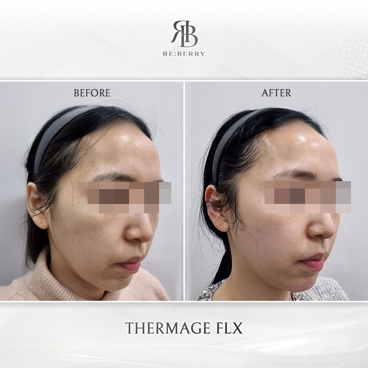 Thermage FLX before and after photo 8, RE:BERRY Clinic Myeongdong