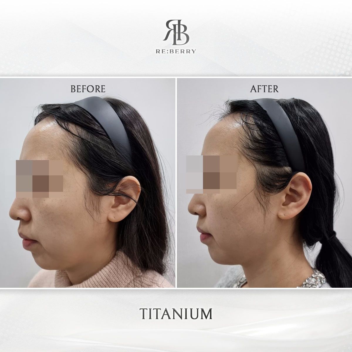 Titanium Lifting before and after at RE:BERRY Clinic Myeongdong