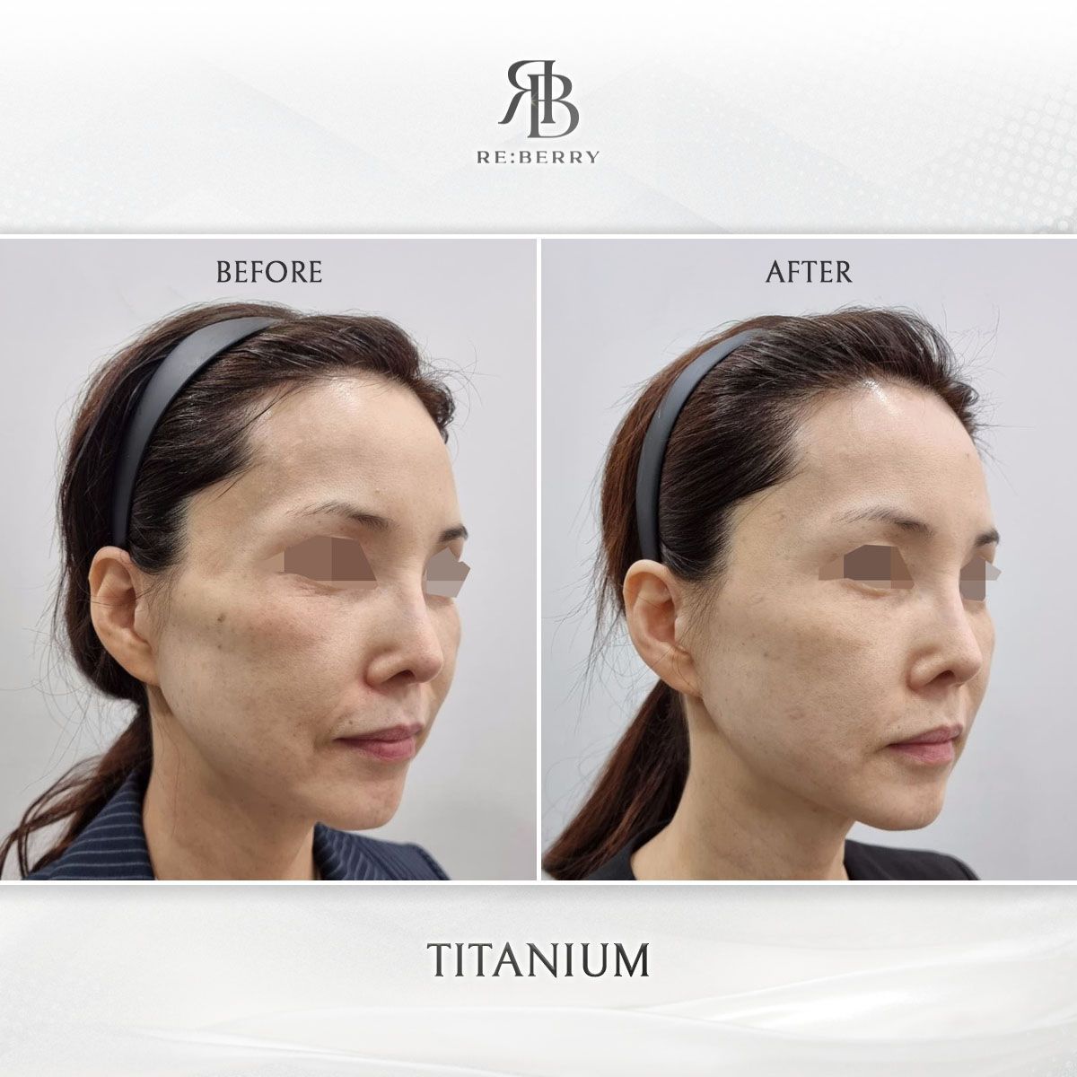 Titanium Lifting before and after photo 10, RE:BERRY Clinic Myeongdong