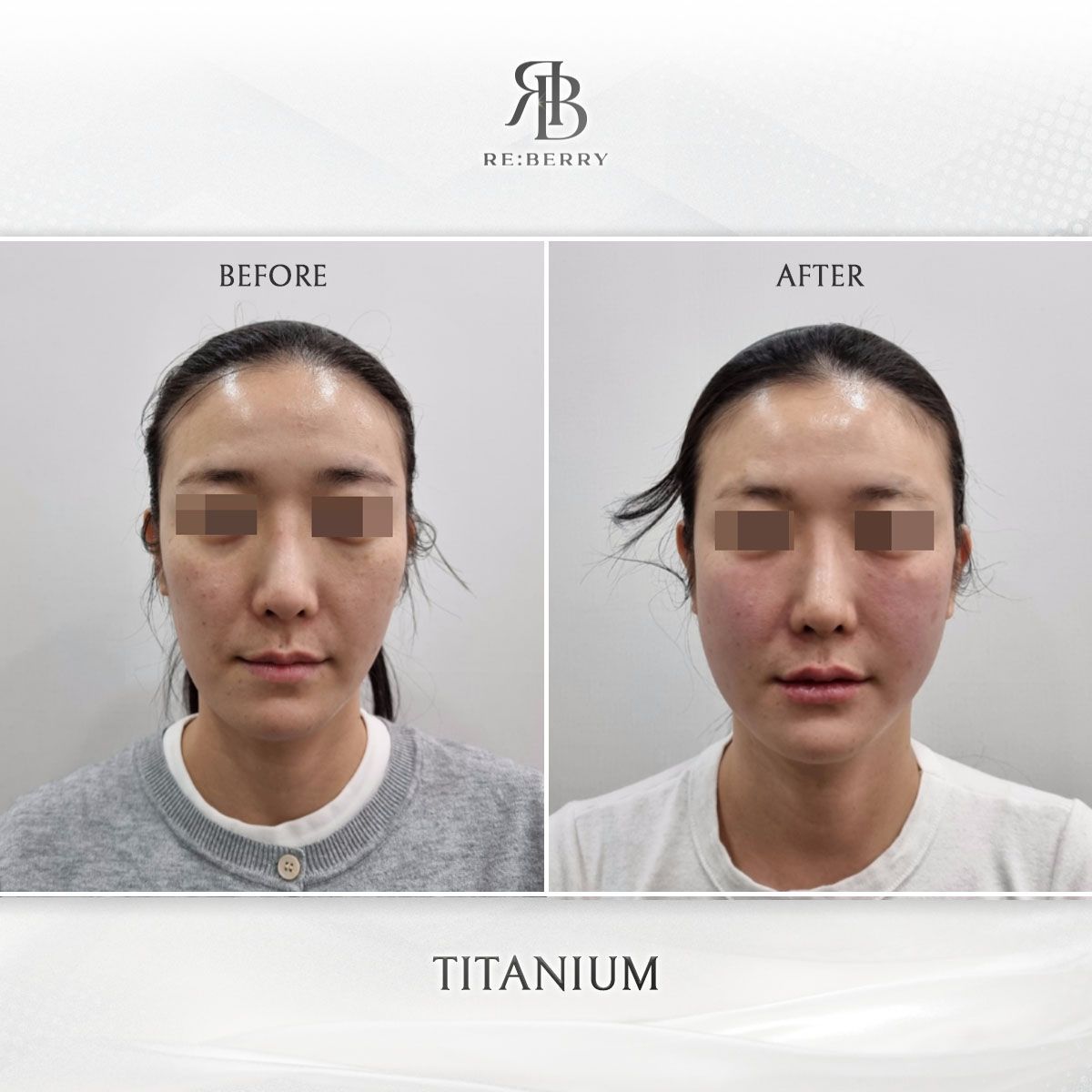 Titanium Lifting before and after photo 15, RE:BERRY Clinic Myeongdong