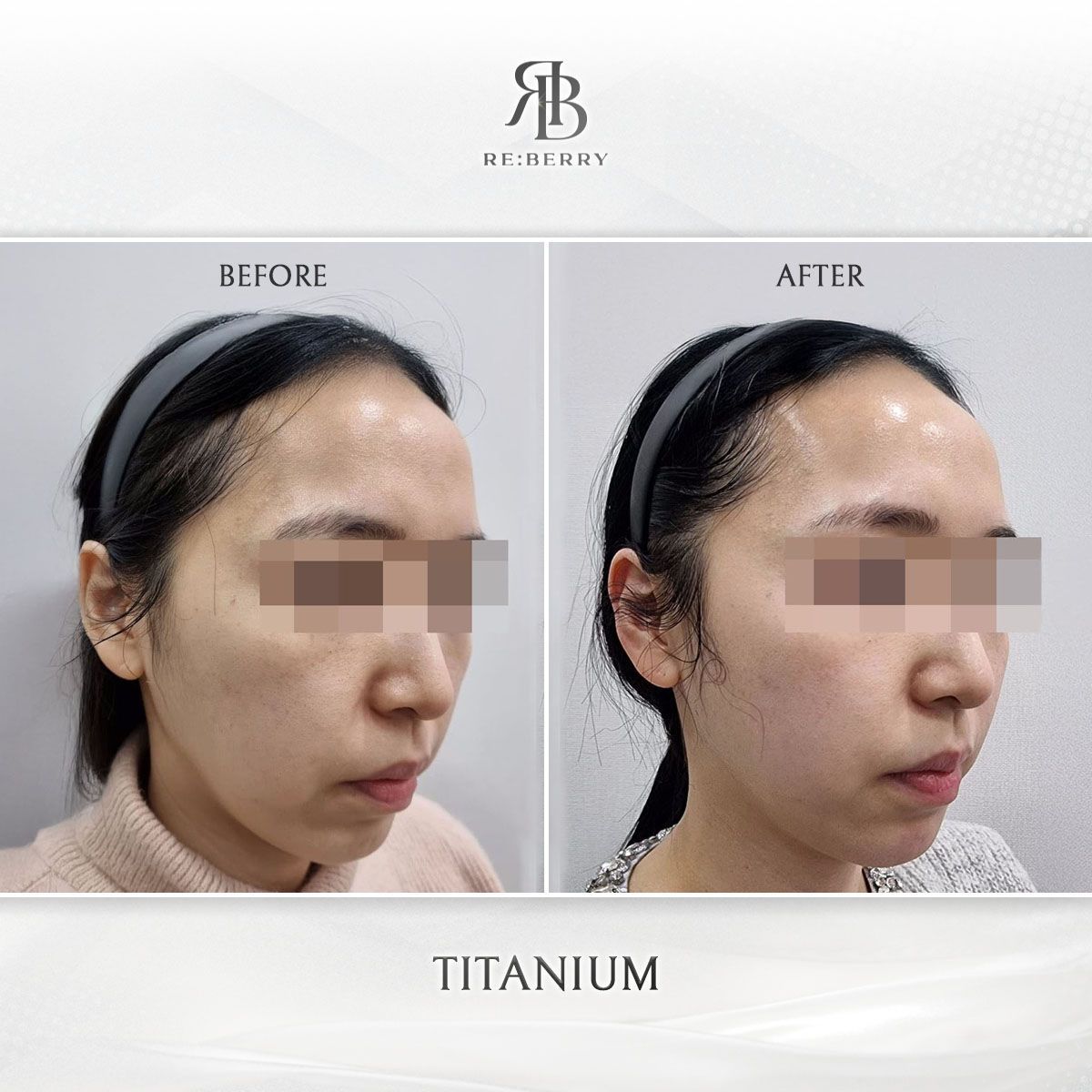Titanium Lifting before and after photo 6, RE:BERRY Clinic Myeongdong