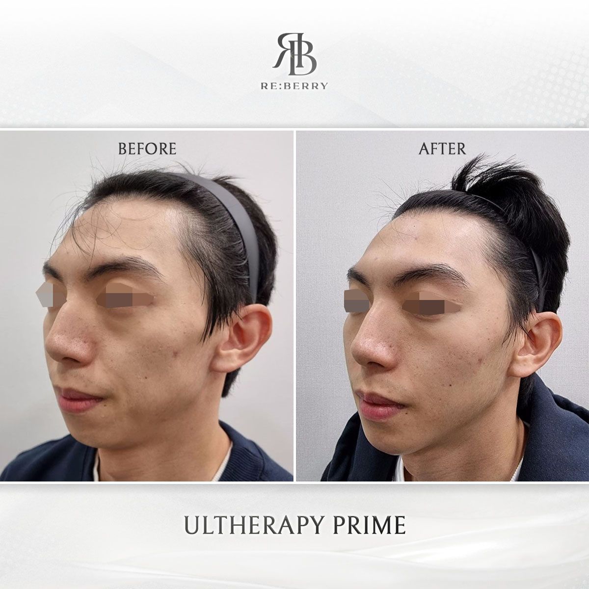 Ultherapy Prime before and after at RE:BERRY Clinic Myeongdong